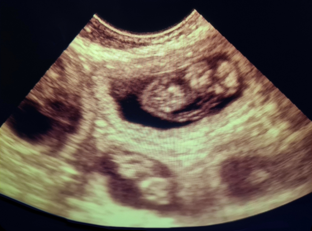 Ultrasound 3