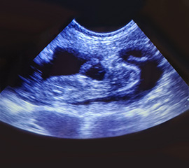 Ultrasound